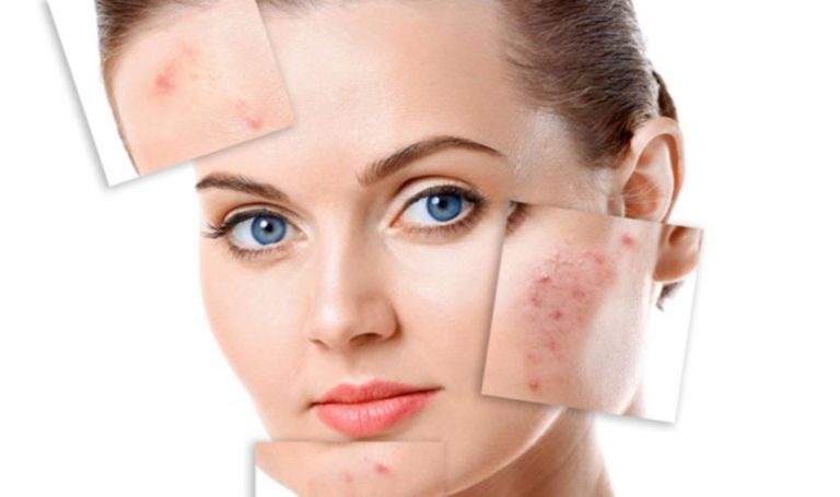 Sivilceleriniz sağlığınızla ilgili sırları saklıyor olabilir: Sivilcelerin ortaya çıktığı alanlar ve anlamları… – Son Dakika Hayat Haberleri